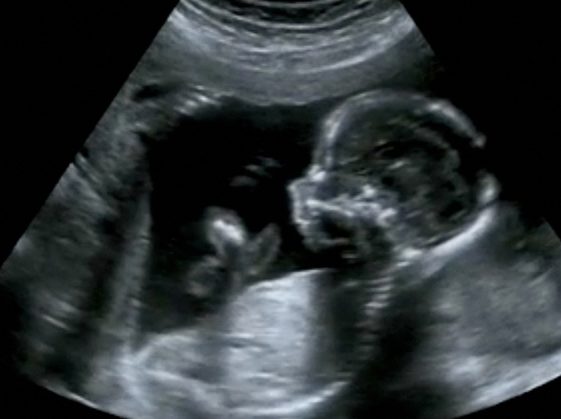 Obstetric Ultrasonography Ultrasound Echography of a first month / ©jovannig - stock.adobe.com, jovannig - stock.adobe.com Obstetric Ultrasonography Ultrasound Echography of a fourth month fetus